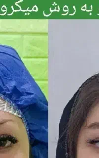 جشنواره کاشت مو و ابرو با تخفیف ویژه