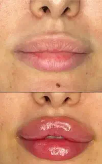 زیبایی ساکشن و ژل بوتاکس