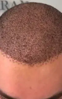 کاشت مو تخصصی ایلام