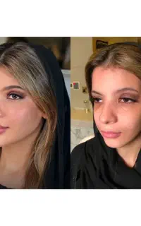 فیلرژل بوتاکس،کربوکسی،مزوفیشال،ریموتتوخال نخ لیفت