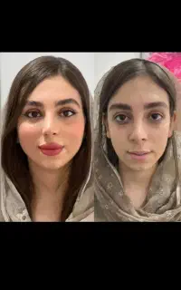 آف 40 پی ارپی مو اقایان ژل بوتاکس مزوتراپی انزیم