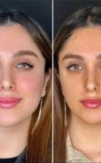 تخفیف ژل فیلربادی نخ بوتاکس پی ار پی مزو انزیم چال