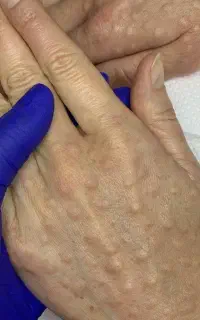 افر ویژه بوتاکس