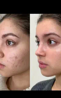 کربوکسی تراپی پوست کره ای