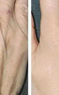 فیلر و جوان سازی دست