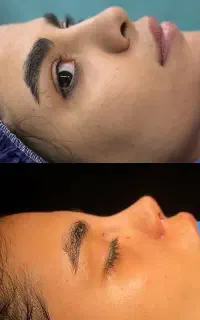 عمل‌ زیبایی‌ و جراحی بینی