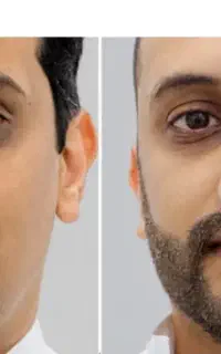 ریش، جای خالی در صورت یا رشد نامنظم