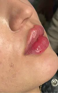 کلینیک تخصصی فیلر لب با تکنیک M روسی عروسکی باربی