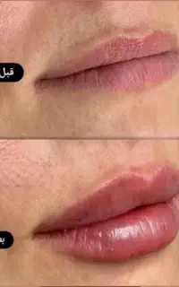 پی آرپی ۸۵۰بوتاکس ۸۵۰فیلر ۸۵۰
