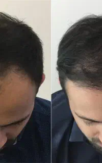 موهات کم پشتی شده،( پروتئین تراپی)