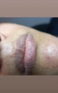 شیدینگ لب بدون درد و ورم