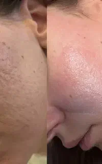 فیشال تخصصی.درمان لک و جوش با دستگاه های تخصصی