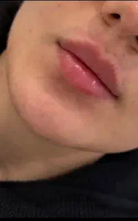 جشنواره عید تزریق ژل بوتاکس مزو ژل مزوتراپی