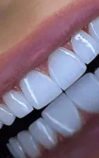 دندانپزشکی کامپوزیت ونیر واحدی ۱میلیون