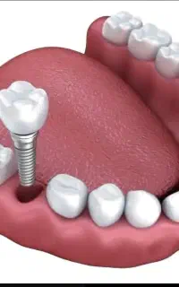 ایمپلنت دیجیتال کرمان