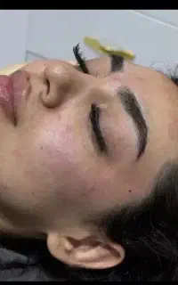 آموزش و تزریق ژل فول فیس و مزوتراپی