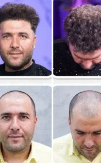 جشنواره تابستانی کاشت مو