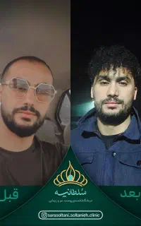 کاشت مو پرتراکم با طراحی خط رویش مو