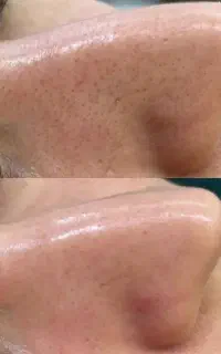 تخفیف ویژه پاکسازی پوست