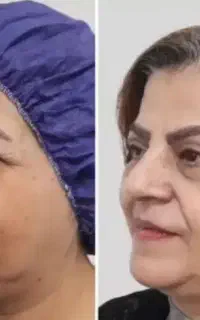 جشنواره تخفیفات بلفاروپلاستی