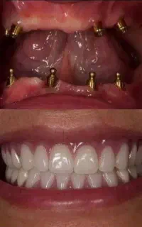جشنواره ایمپلنت و دندانپزشکی با اقساط بلندمدت