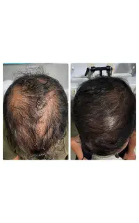 بدون برش و‌جراحی ۳۰ روز موهاتو برمیگردونیم