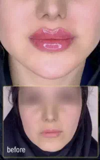 آف خدمات مطب ژل و بوتاکس پک های مادلینگ