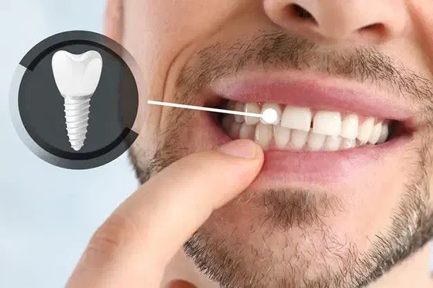 کاشت ایمپلنت دندان اقساطی تا 12 ماه|خدمات آرایشگری و زیبایی|یزد, |دیوار