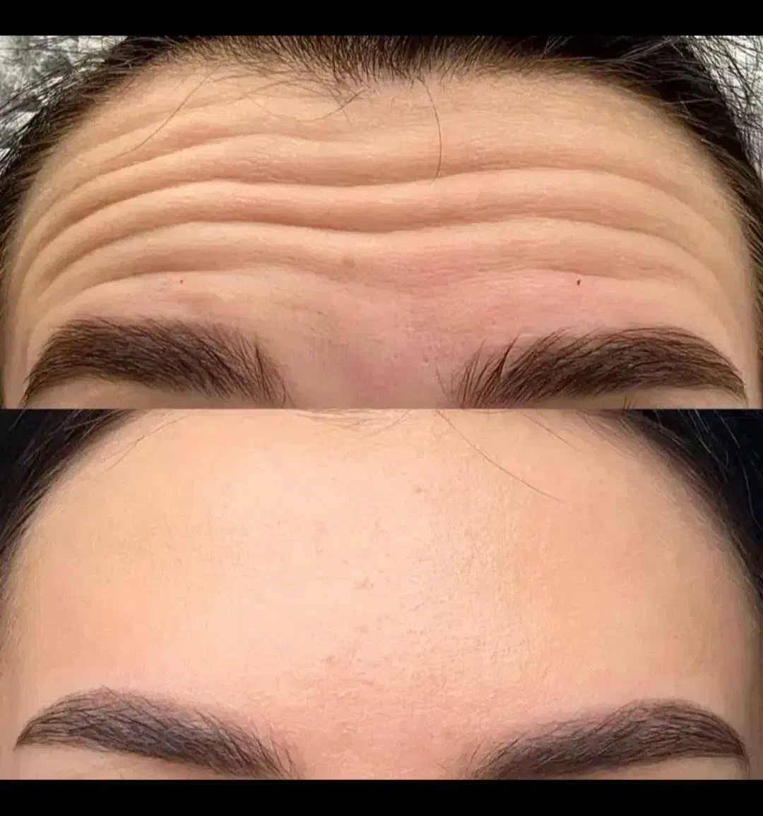 ژل و بوتاکس و مزو ژل|خدمات آرایشگری و زیبایی|بومهن, |دیوار