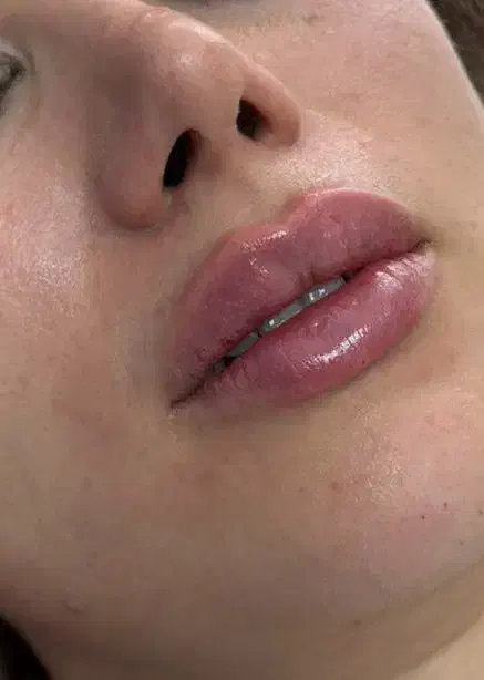 نیازمند مدل رایگان فیلر بوتاکس و prp کاشت نخ|خدمات آرایشگری و زیبایی|رشت, منظریه|دیوار