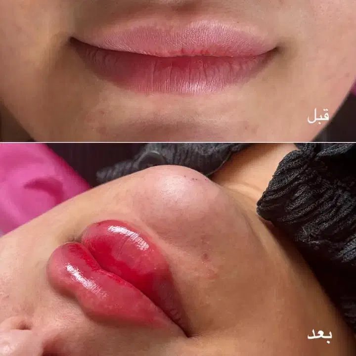 فیلر لب روسی عروسکی|خدمات آرایشگری و زیبایی|سلماس, |دیوار