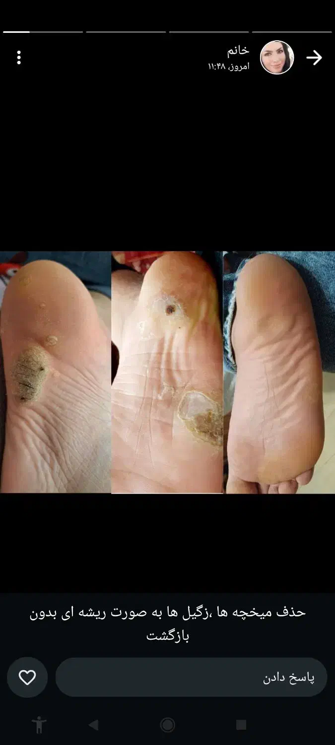 حذف وریشه کن شدن زگیل تناسلی بامحلول گیاهی|خدمات آرایشگری و زیبایی|اصفهان, بوستان ناژوان|دیوار