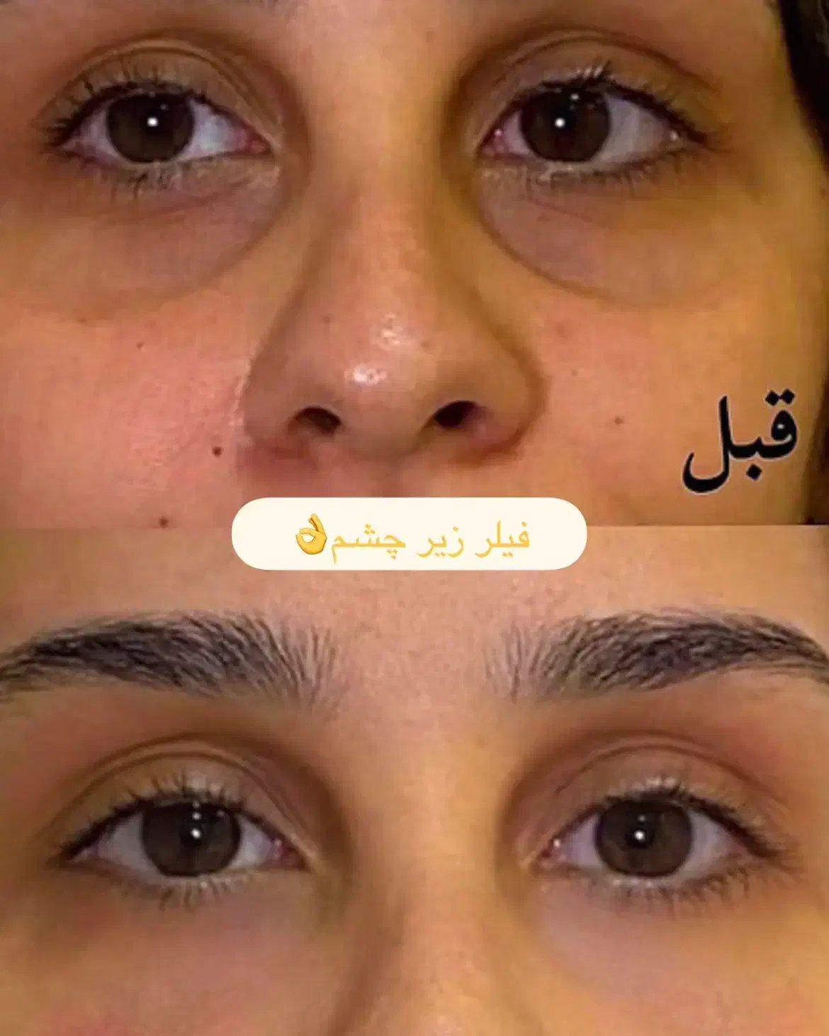 پی آرپی آمریکا۶۵۰ ژل ۷۵۰ بوتاکس ۷۹۰بوتاکس زیربغل|خدمات آرایشگری و زیبایی|اصفهان, خلجا|دیوار