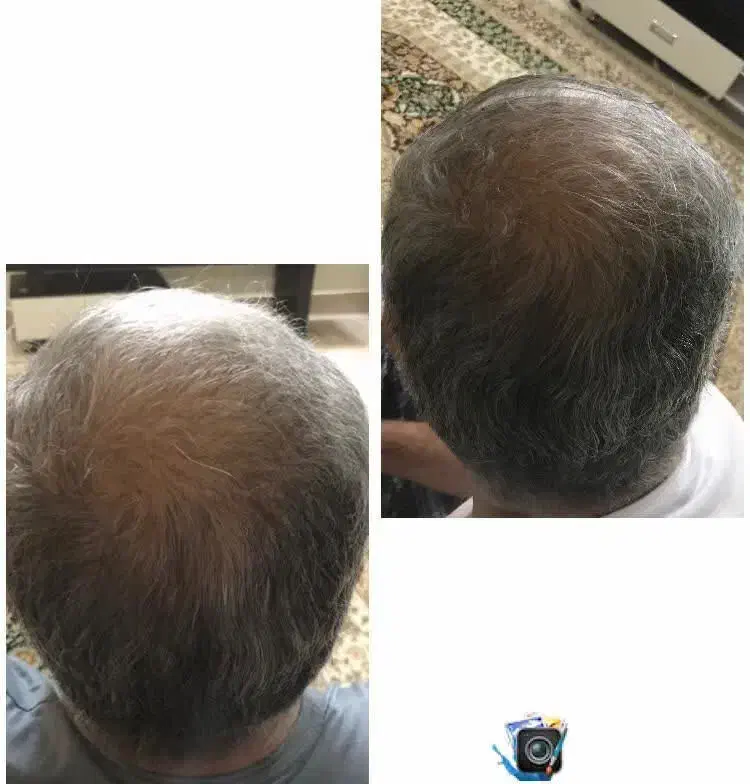 قطره ریزش|آرایشی، بهداشتی، درمانی|کاشان, فاز ۲ ناجی آباد|دیوار