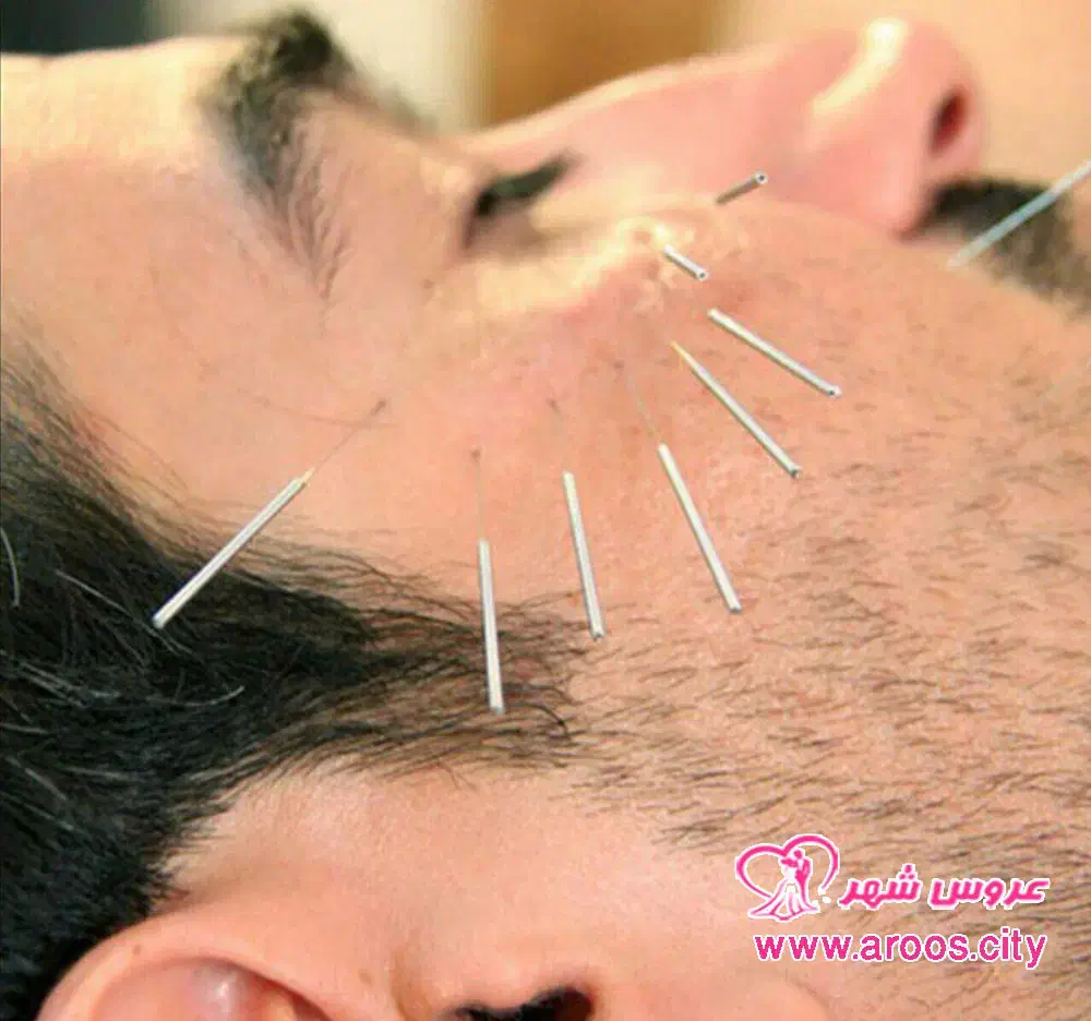 طب سوزنی (چینی)|خدمات آرایشگری و زیبایی|اهواز, فرهنگ شهر|دیوار