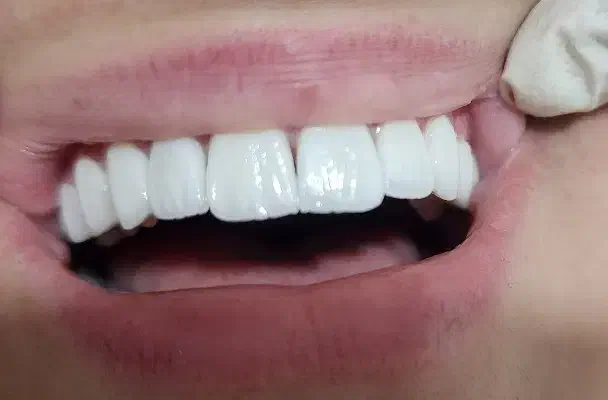 دندان (لمینیت،کامپوزیت و|خدمات آرایشگری و زیبایی|نورآباد, |دیوار