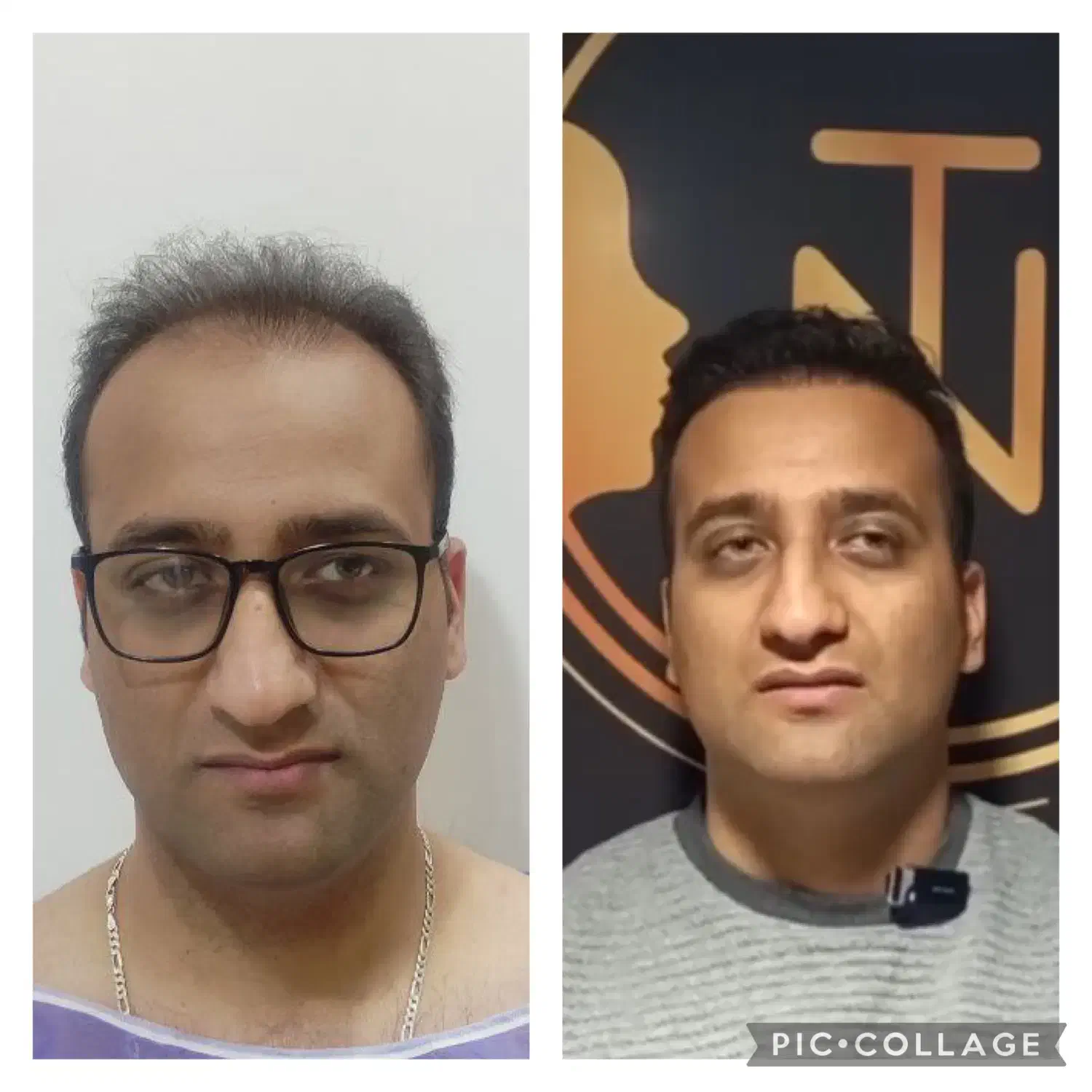 کاشت مو و ابرو با ضمانتنامه کتبی با ۸ ملیون تومان|خدمات آرایشگری و زیبایی|تهران, پاسداران|دیوار