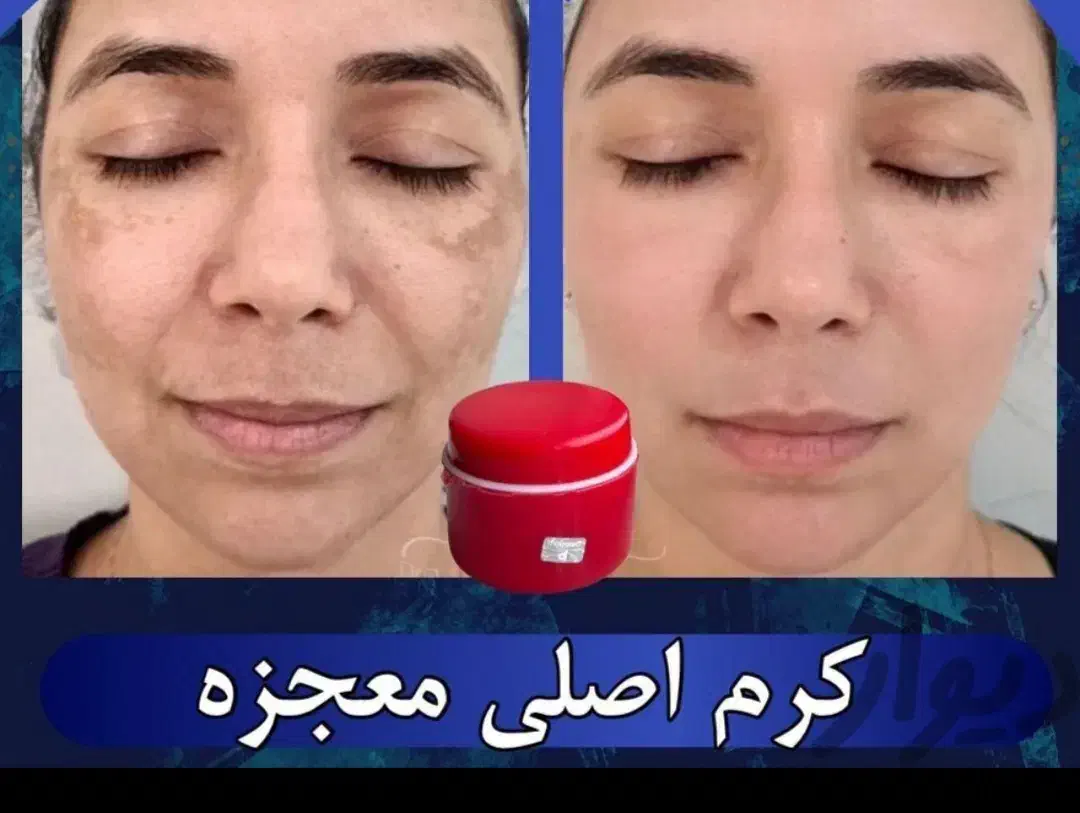 کرم سوپر معجزه صدرصد اصلی و ضمانتی|آرایشی، بهداشتی، درمانی|سنندج, |دیوار