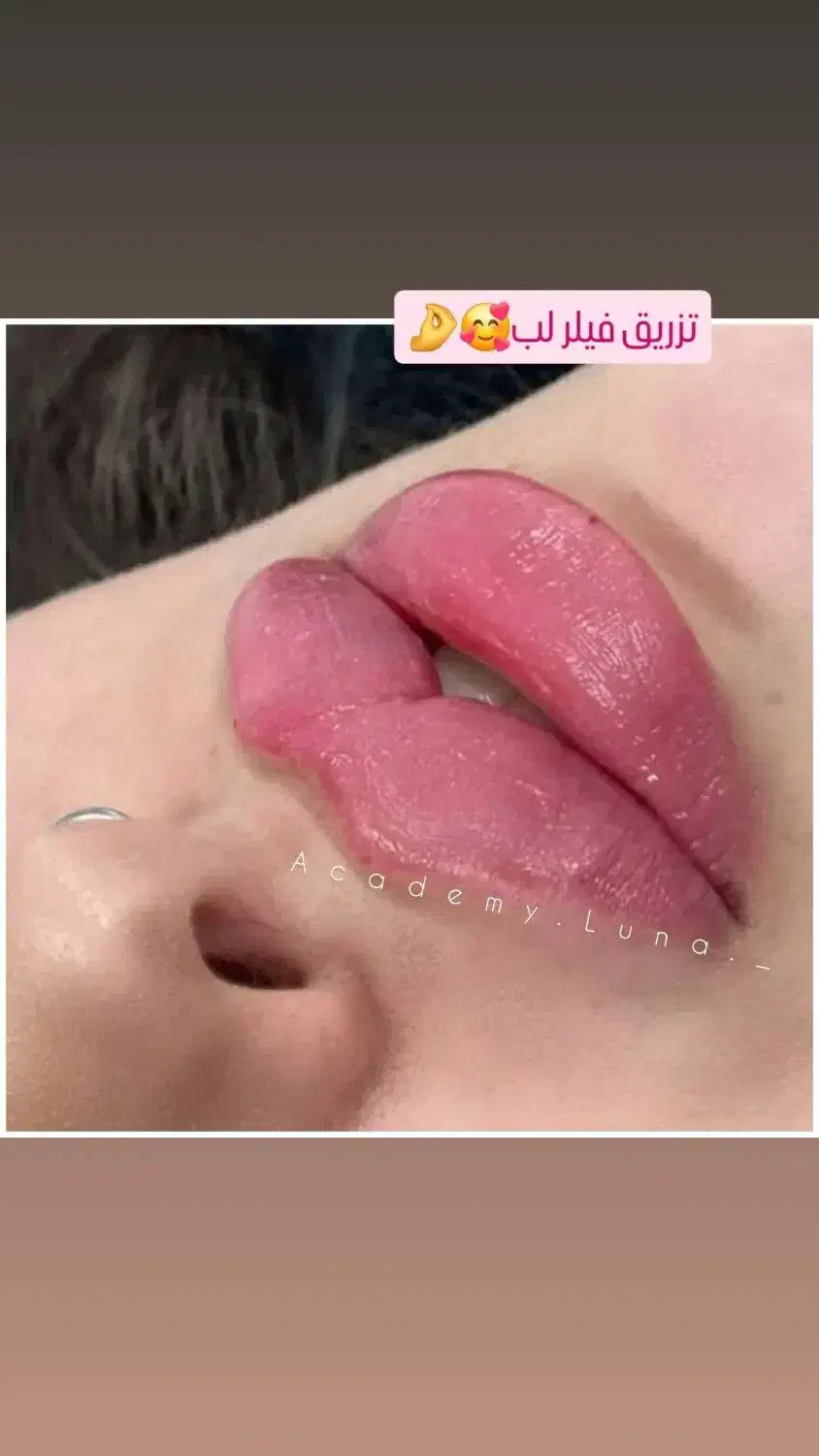 بوتاکس رایگان|خدمات آرایشگری و زیبایی|قم, زنبیل آباد|دیوار