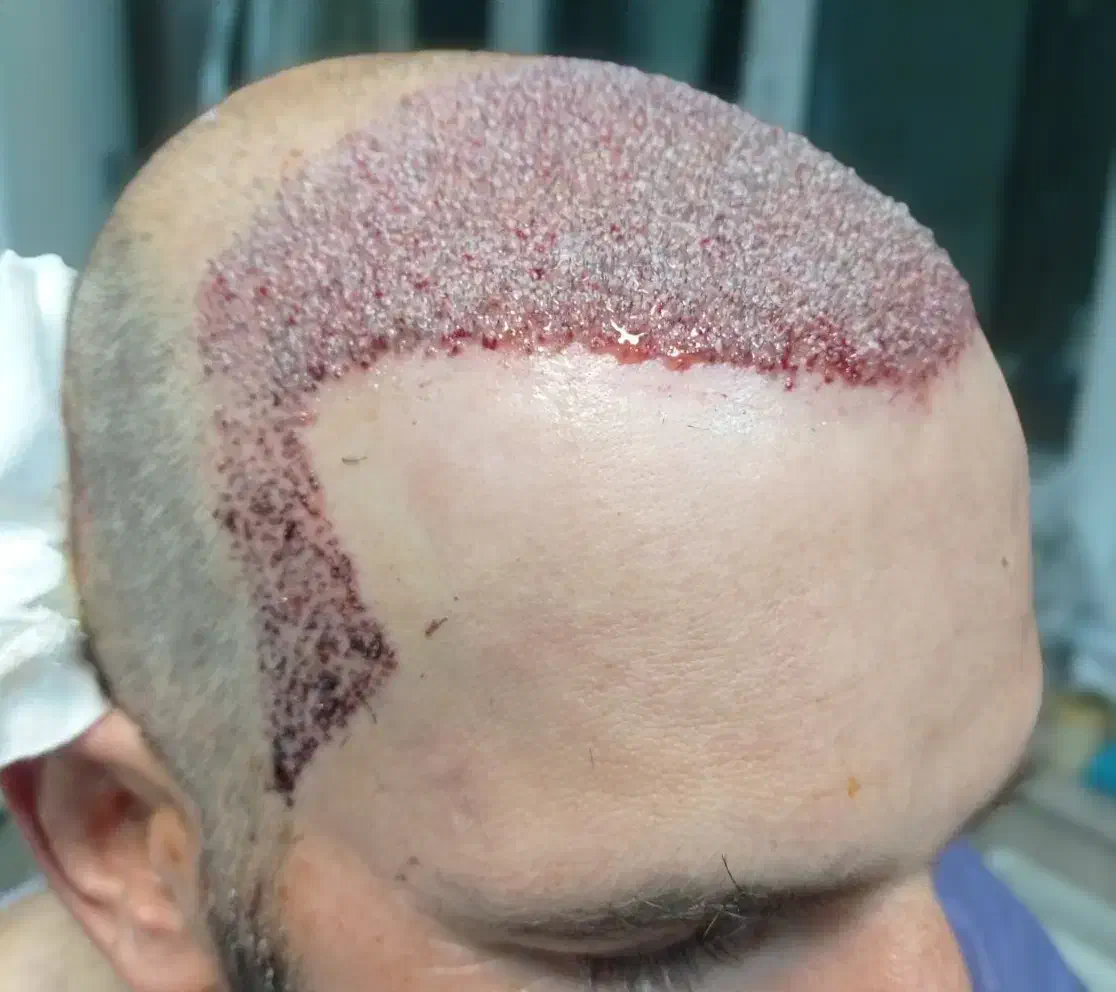 کاشت مو طبیعی|خدمات آرایشگری و زیبایی|بافق, |دیوار