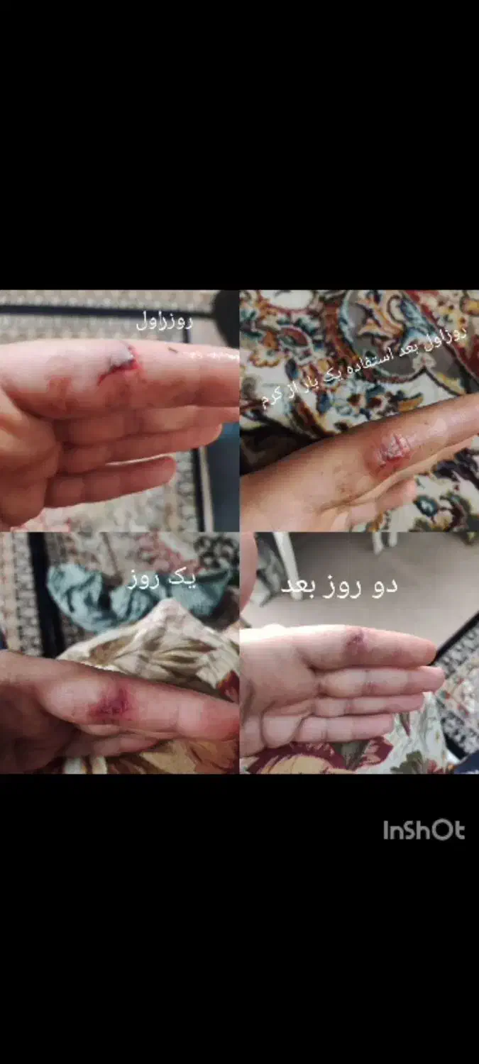 ترمیم زخم سوختگی|آرایشی، بهداشتی، درمانی|قم, حنیف نژاد|دیوار