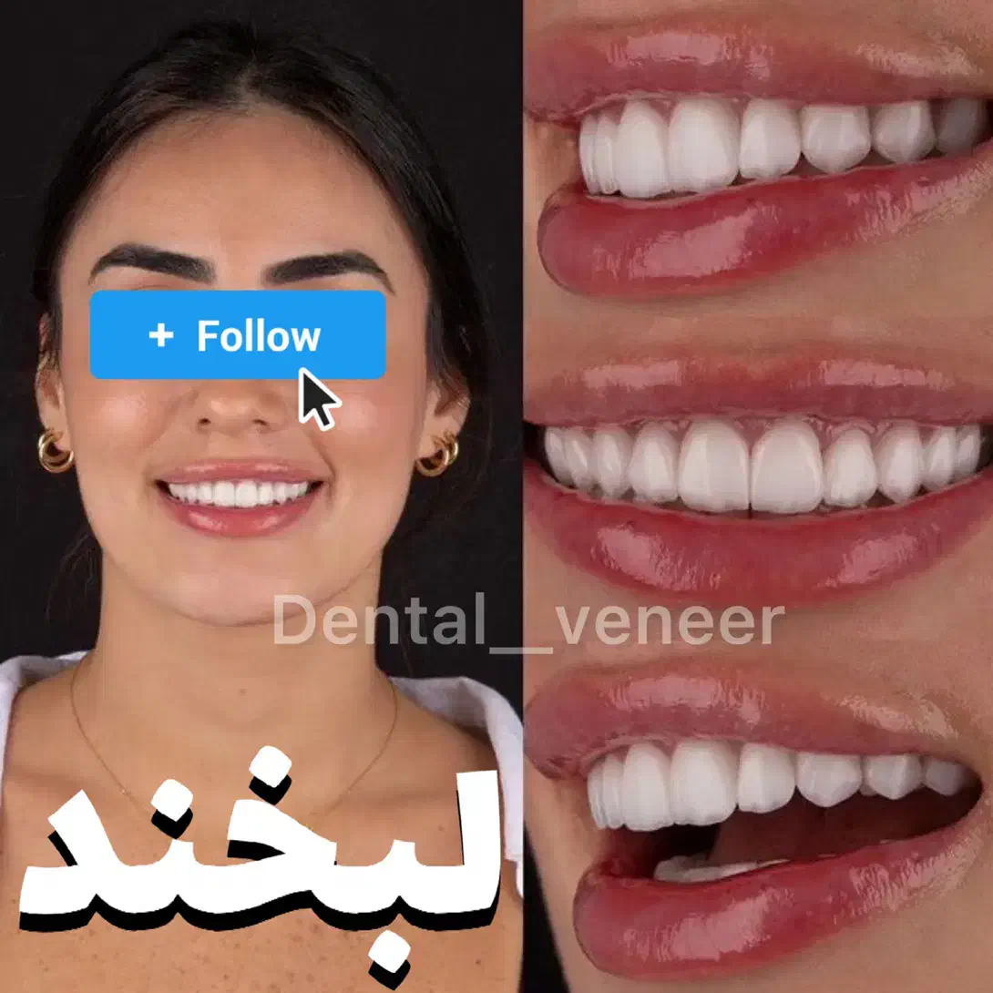 دندانپزشکی ایمپلنت کامپوزیت لمینت ( اقساط بدون سود|خدمات آرایشگری و زیبایی|تهران, الهیه|دیوار