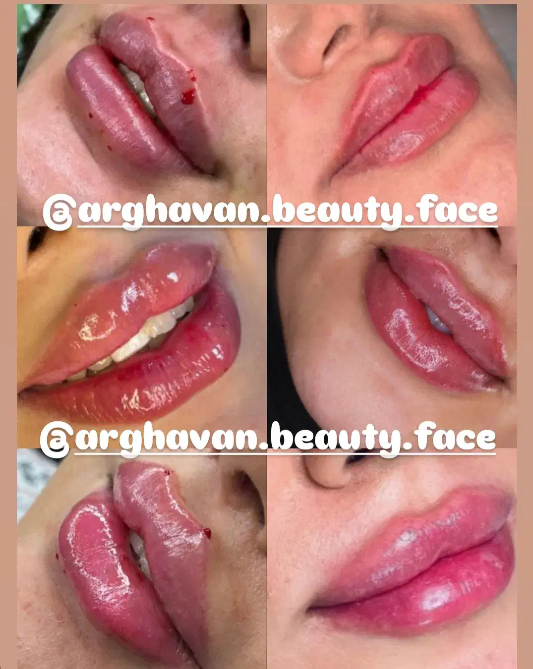 ژل و بوتاکس مزوتراپی و مزونیدلینگ آرایش دایم|خدمات آرایشگری و زیبایی|اردکان, |دیوار