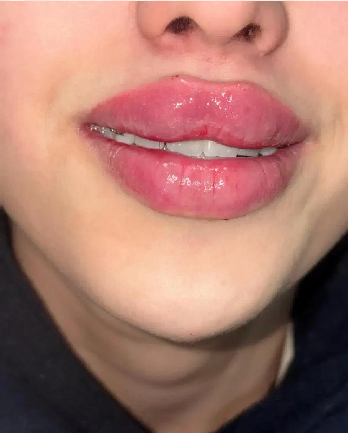 تزریق فیلر،ژل لب،فیلربینی|خدمات آرایشگری و زیبایی|شیراز, ریشمک|دیوار