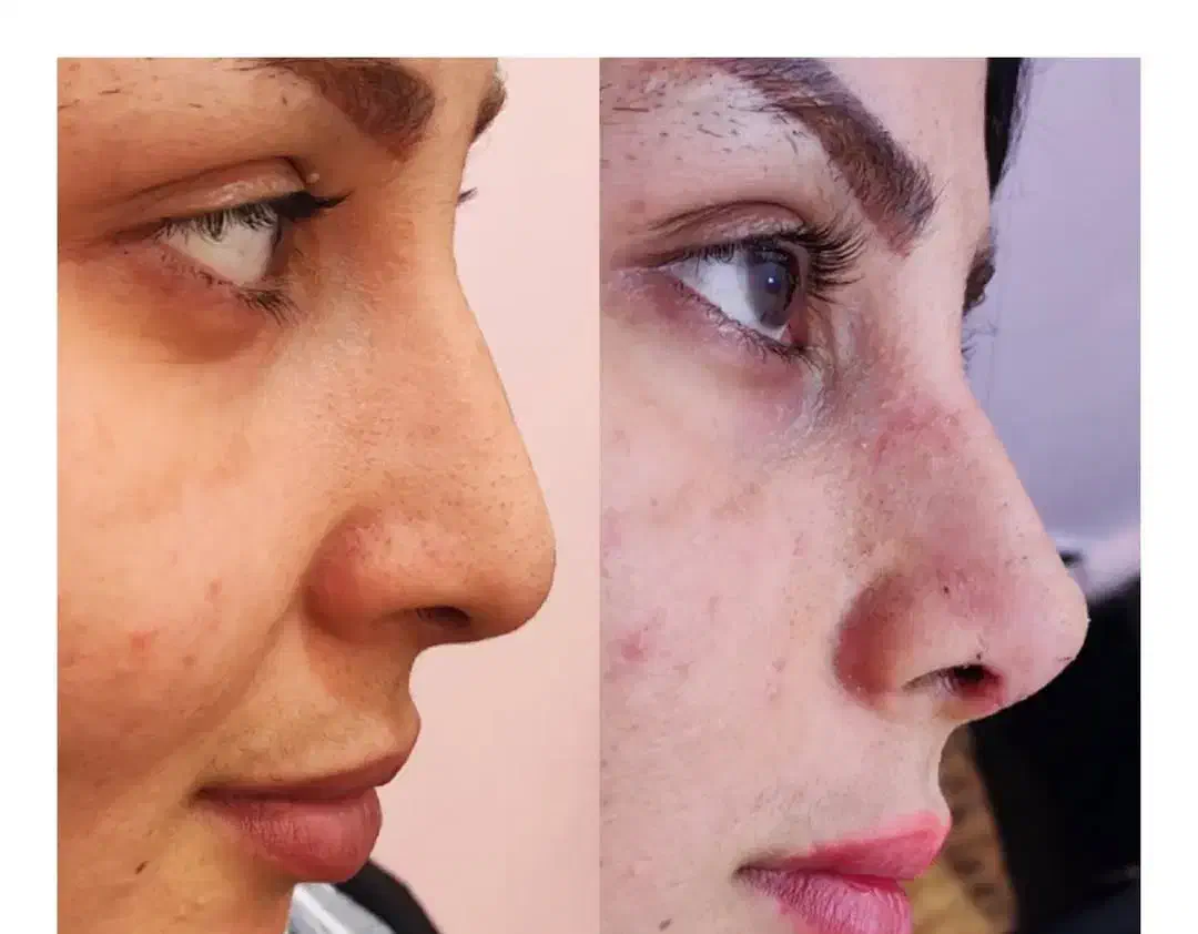 مژده همشهریان عزیزتخفیف 30 درصد خدمات جراحی ساکشن|خدمات آرایشگری و زیبایی|بروجرد, |دیوار