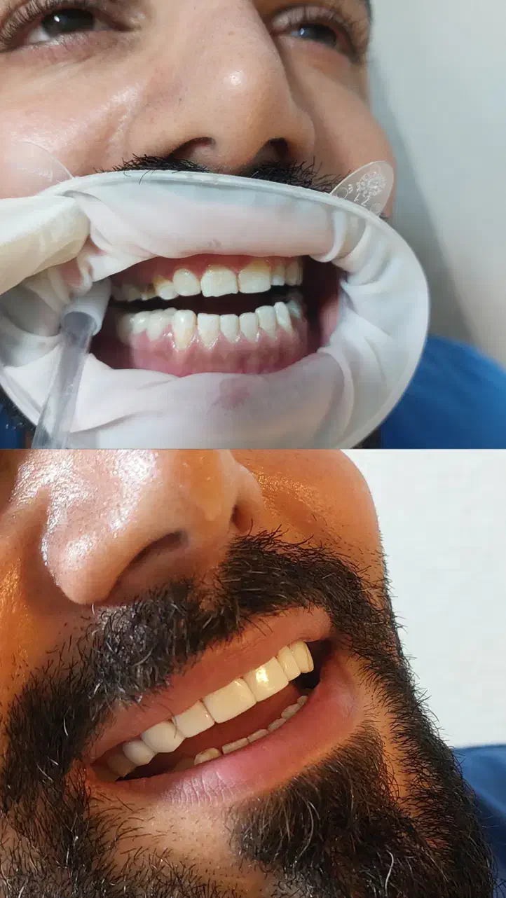 آف ویژه خدمات تخصصی کامپوزیت دندان|خدمات آرایشگری و زیبایی|شاهین‌شهر, فردوسی|دیوار