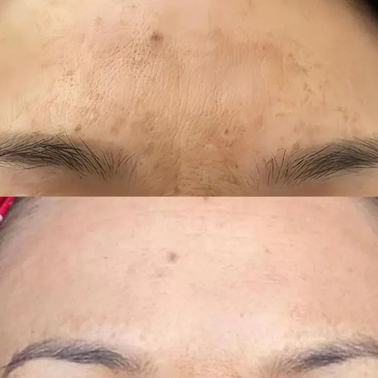 مزونیدلینگ ، PRP ، مزوتراپی صورت و مو|خدمات آرایشگری و زیبایی|دوگنبدان, |دیوار