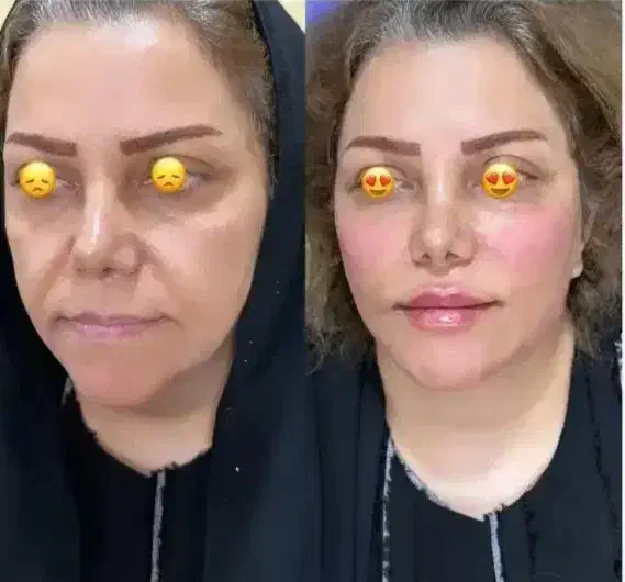 ژل تمام نقاط صورت فقط ۵۵۰تا دوشنبه|خدمات آرایشگری و زیبایی|بم, |دیوار