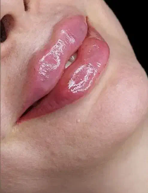 جشنواره ی تخفیفات تزریق چربی|خدمات آرایشگری و زیبایی|مشکین‌دشت, |دیوار