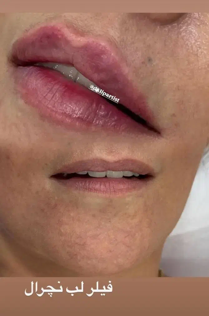 فیلر لب،چونه،گونه،فول فیس،باسن|خدمات آرایشگری و زیبایی|مشهد, سجاد شهر|دیوار